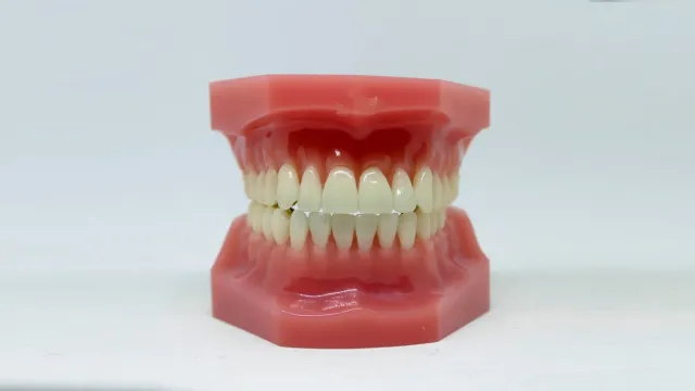Denture model used to compare tooth replacement options
