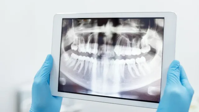 Dental X-ray shown on a tablet