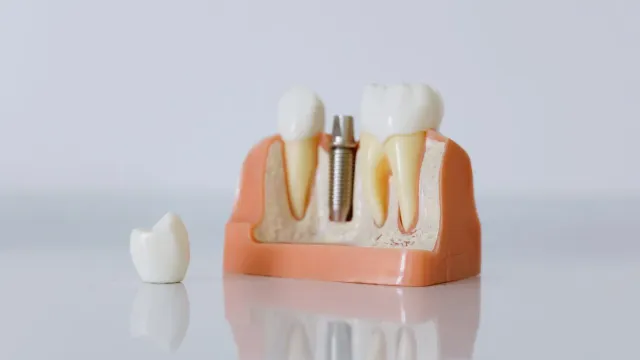 Dental implant model with a crown