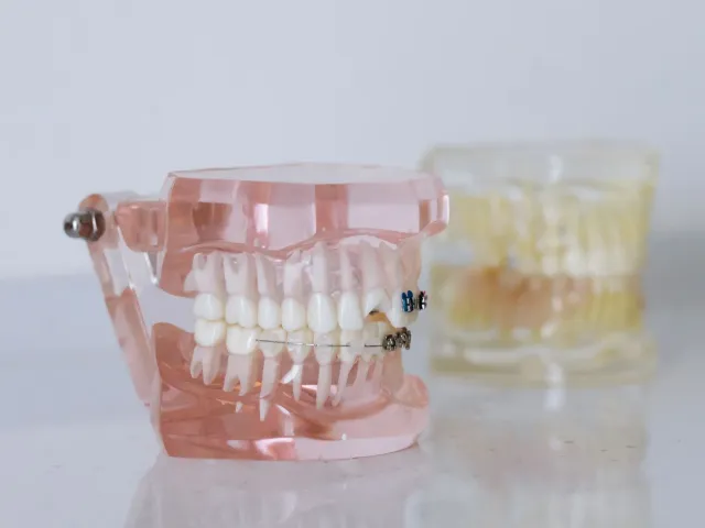 Clear dental models used to plan crowns and bridges