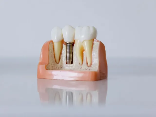 Cross-section model of a dental implant beside natural teeth