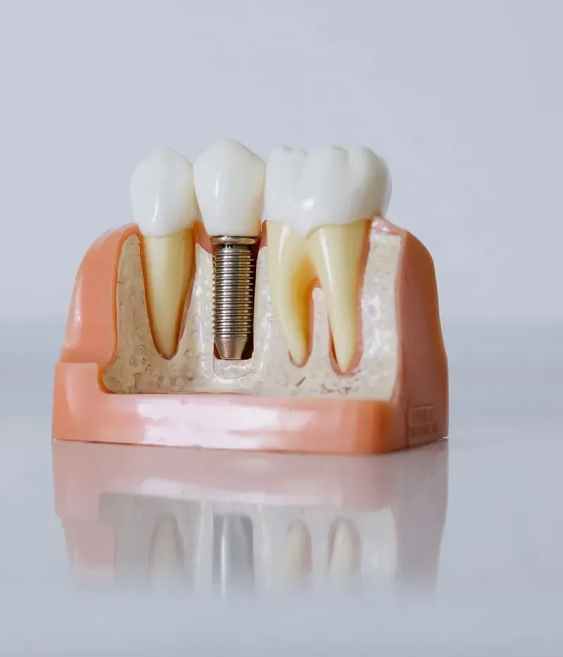 Dental Implants at Radiant Dentistry ATX in Pflugerville, TX